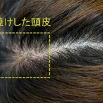 日焼けした頭皮は早めに対処 【スキャルプケア編】